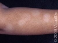 Pityriasis Alba