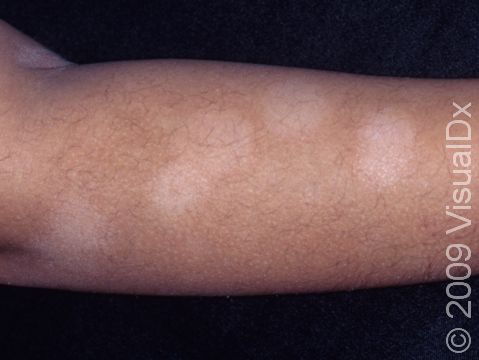 There may be numerous flat, lighter-colored, nonscaling areas with pityriasis alba.