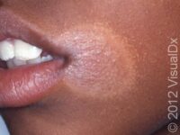 Pityriasis Alba