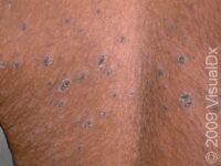 Pityriasis Rosea