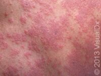 Pityriasis Rosea