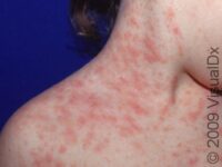 Pityriasis Rosea