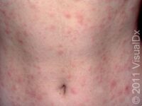 Pityriasis Rosea