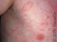 Pityriasis Rosea – Adult