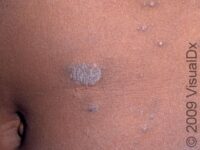 Pityriasis Rosea