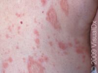 Pityriasis Rosea