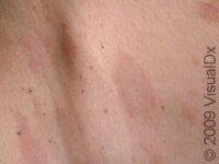 Pityriasis Rosea