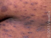Pityriasis Rosea