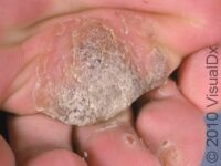 Plantar Wart