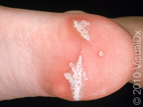 This image displays a recurrent wart on the heel and a scar due to surgery for removal of original wart.