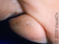 Plantar Wart