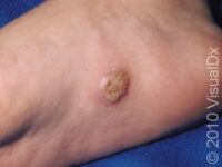 Plantar Wart – Adult