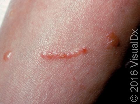 This image displays allergic contact dermatitis due to exposure to poison ivy.