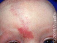 Port-Wine Stain – Infant