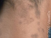 Post-Inflammatory Hyperpigmentation
