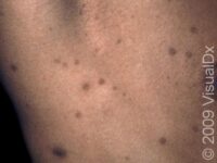Post-Inflammatory Hyperpigmentation