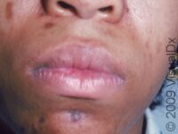 Post-Inflammatory Hyperpigmentation