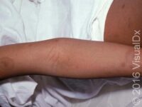 Post-Inflammatory Hyperpigmentation