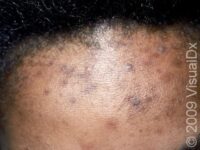 Post-Inflammatory Hyperpigmentation