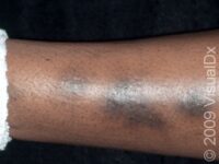 Post-Inflammatory Hyperpigmentation