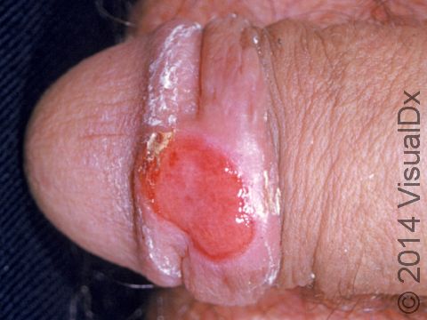 This image displays a chancre, an ulcer of primary syphilis.