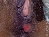 Primary Syphilis – Adult