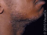 Razor Bumps (Pseudofolliculitis Barbae)