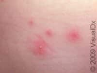 Hot Tub Rash (Pseudomonas Folliculitis)