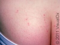 Hot Tub Rash (Pseudomonas Folliculitis)