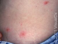 Hot Tub Rash (Pseudomonas Folliculitis)