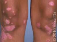 Psoriasis