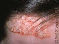 Plaque Psoriasis – Teen