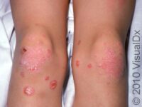 Psoriasis