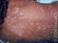 Psoriasis