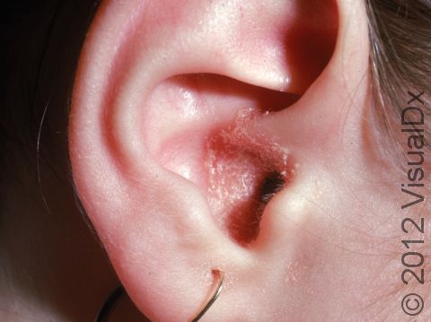 Typical redness and scaling of external ear canal psoriasis.