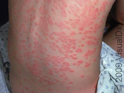 This image displays an extensive case of psoriasis that has been triggered by a strep infection.