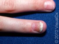 Psoriasis