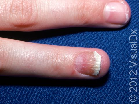 This image displays an uneven, pitted nail separated from the nail bed due to psoriasis.