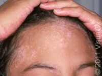 Psoriasis