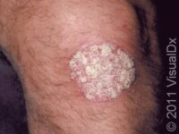 Psoriasis