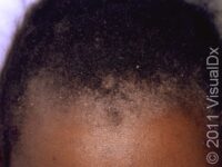Psoriasis