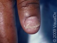 Psoriasis