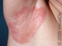Psoriasis
