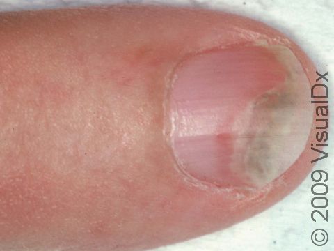 This image displays a separation of the nail from the bed (onycholysis) caused by psoriasis.