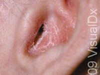 Psoriasis
