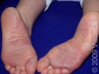 Psoriasis