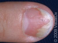 Psoriasis