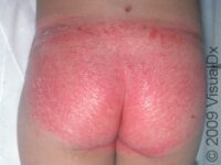 Psoriasis