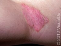 Psoriasis