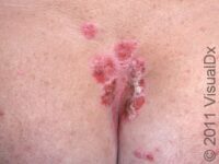 Psoriasis